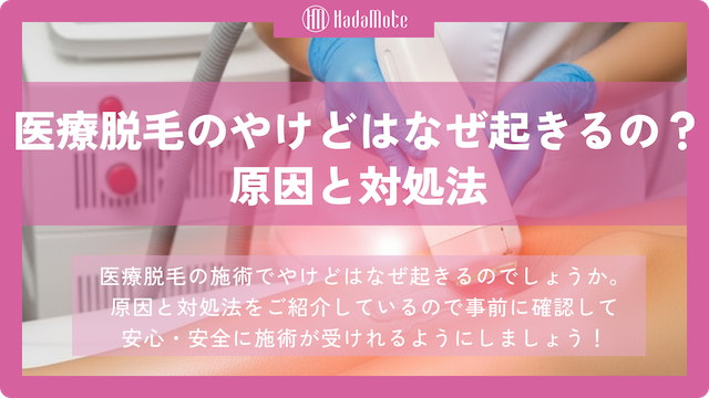 医療脱毛のやけどはなぜ起きるの？原因と対処法をご紹介画像